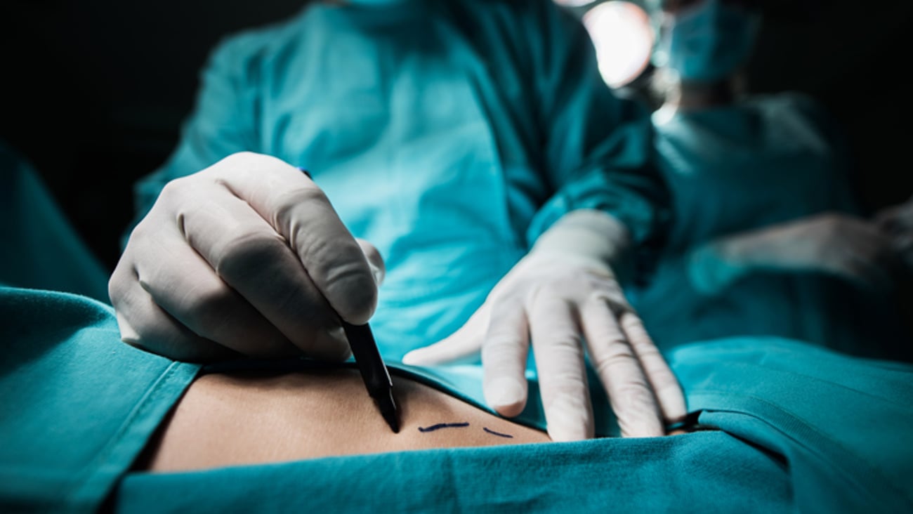 Un plasticien se laisse des marques avant de débuter sa chirurgie.