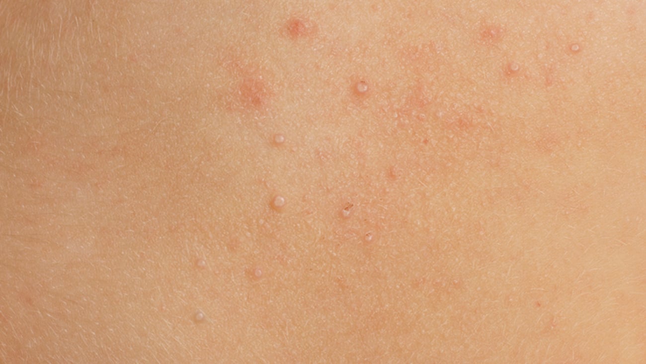 Le molluscum contagiosum (également appelé verrues d'eau) est considéré comme une maladie de peau bénigne et sans gravité.