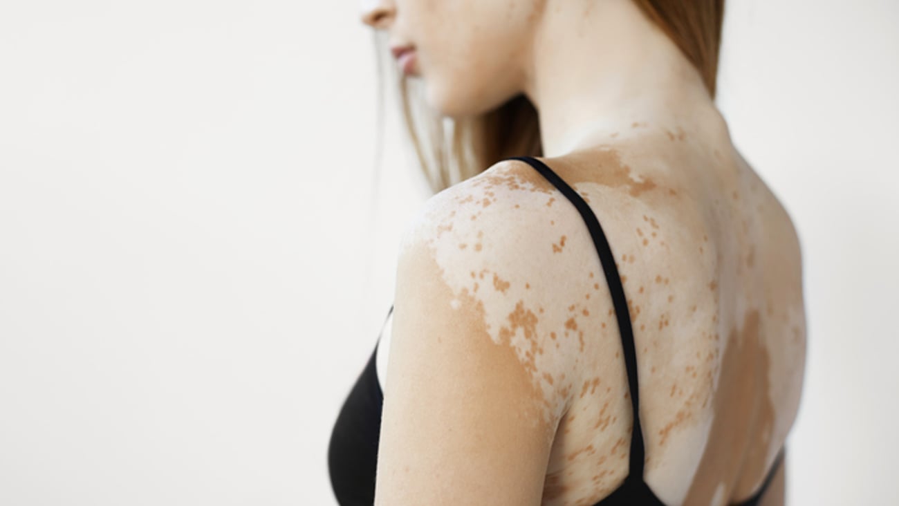 Femme de dos atteinte de vitiligo