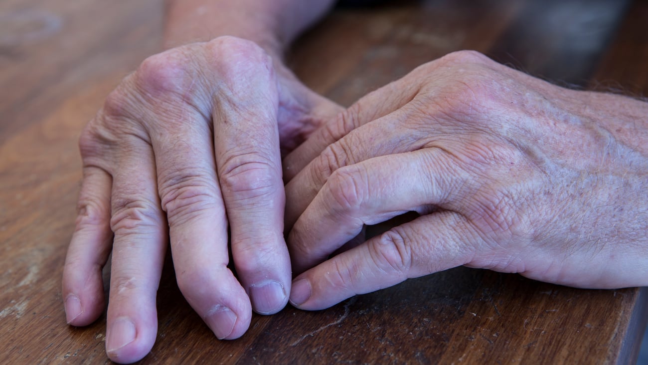 Doigts d'un patient atteint de rhumatisme psoriasique