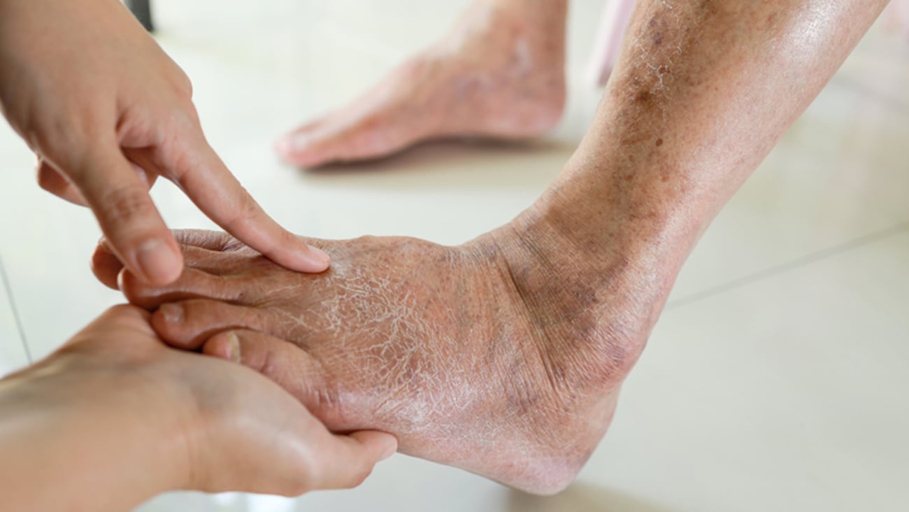 Une personne âgée a des problèmes de peau sur les pieds.