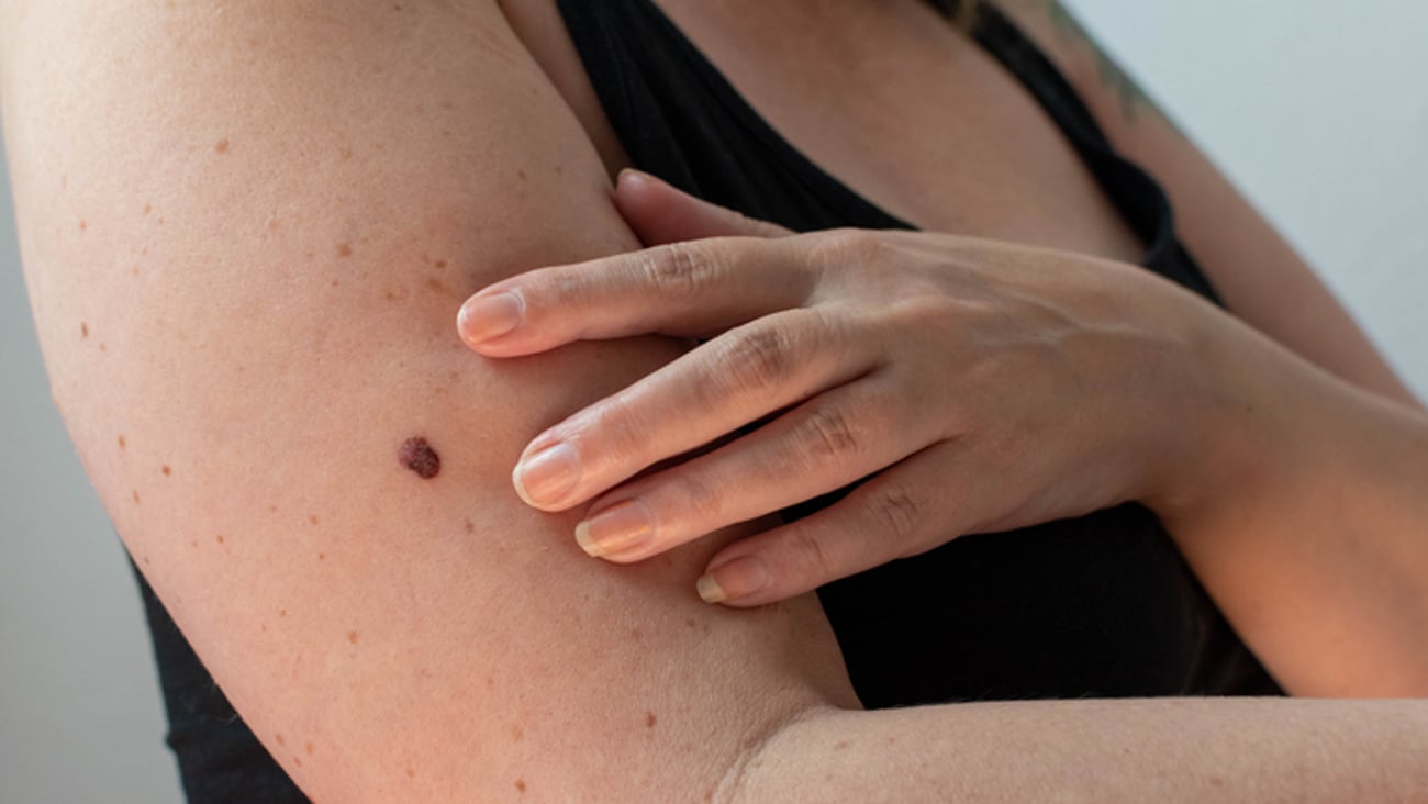 Une femme a des grains de beauté sur le bras.