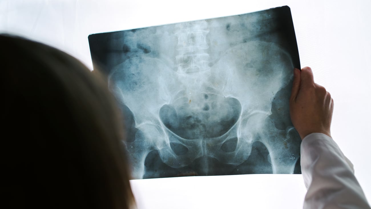 Un médecin examine une radio de la hanche