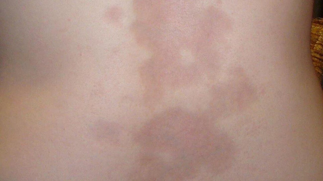 Une sclérodermie localisée (Morphée) située dans le dos d'une femme caucasienne de 16 ans. (Crédit: Leith C Jones/Wikipedia/CC BY 3.0)
