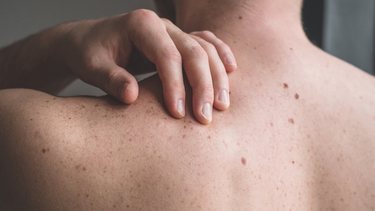 Un homme a plusieurs grains de beauté sur son dos.