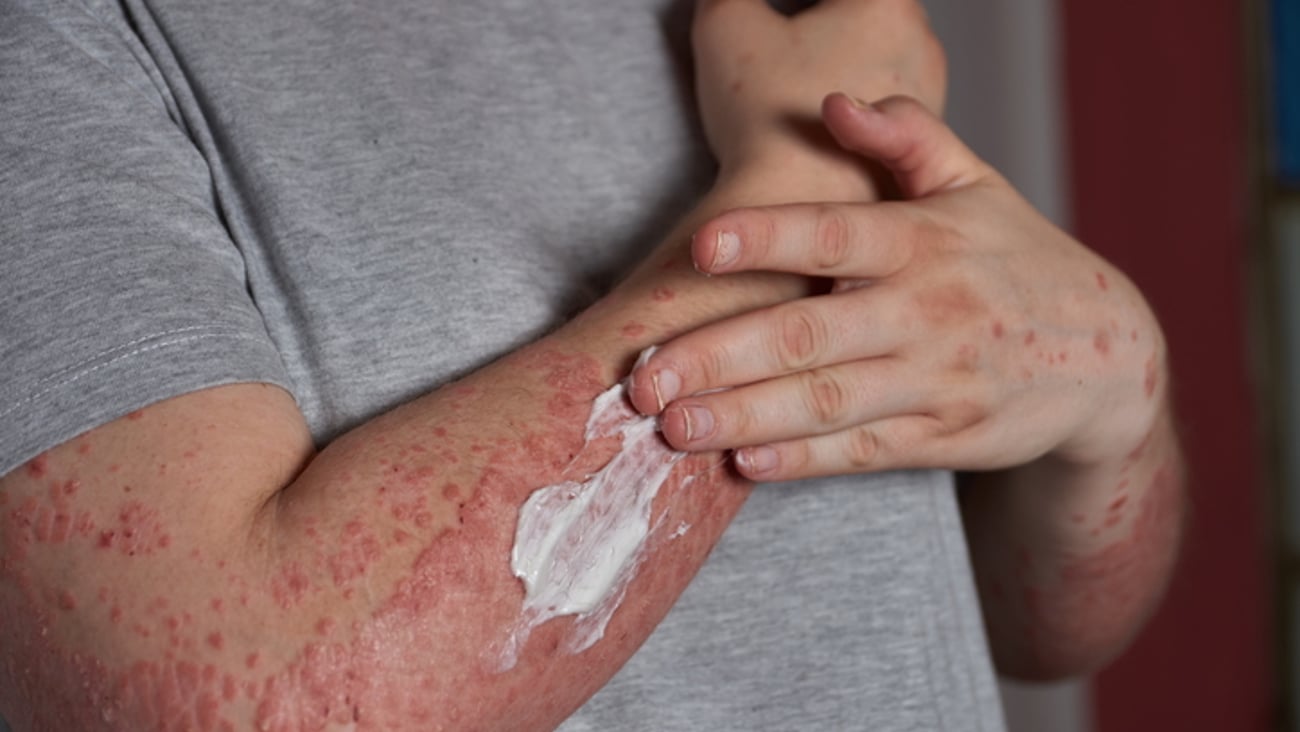 Un homme étend de la crème sur un bras couvert de psoriasis.