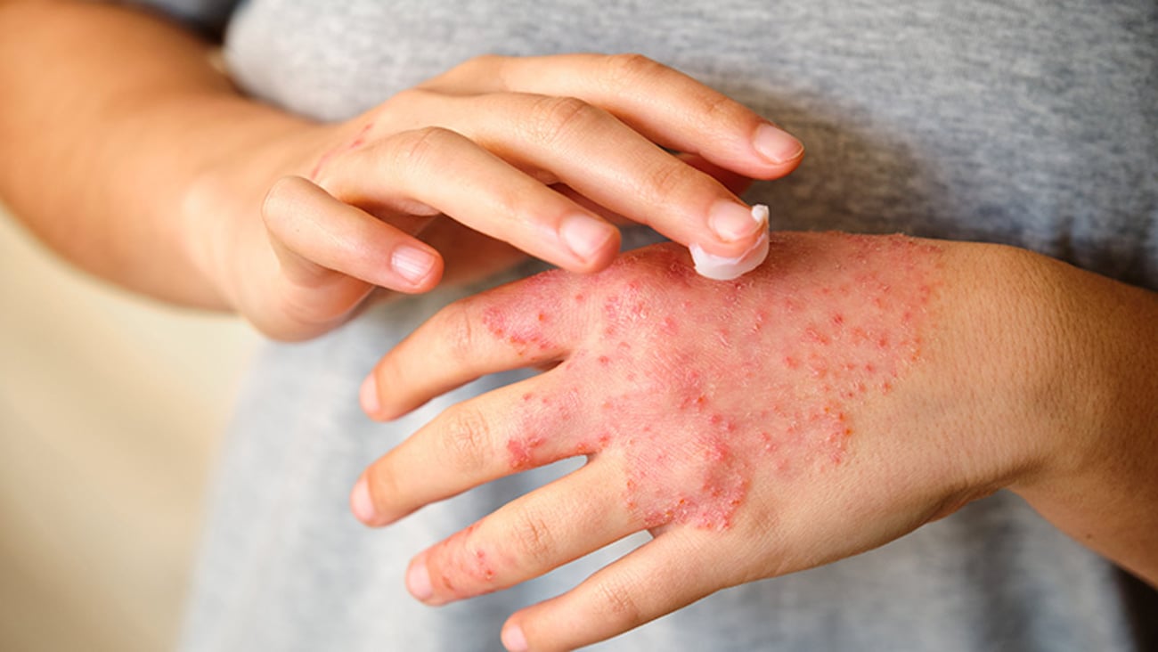 gros plan d'une personne appliquant une crème sur sa main enflammée