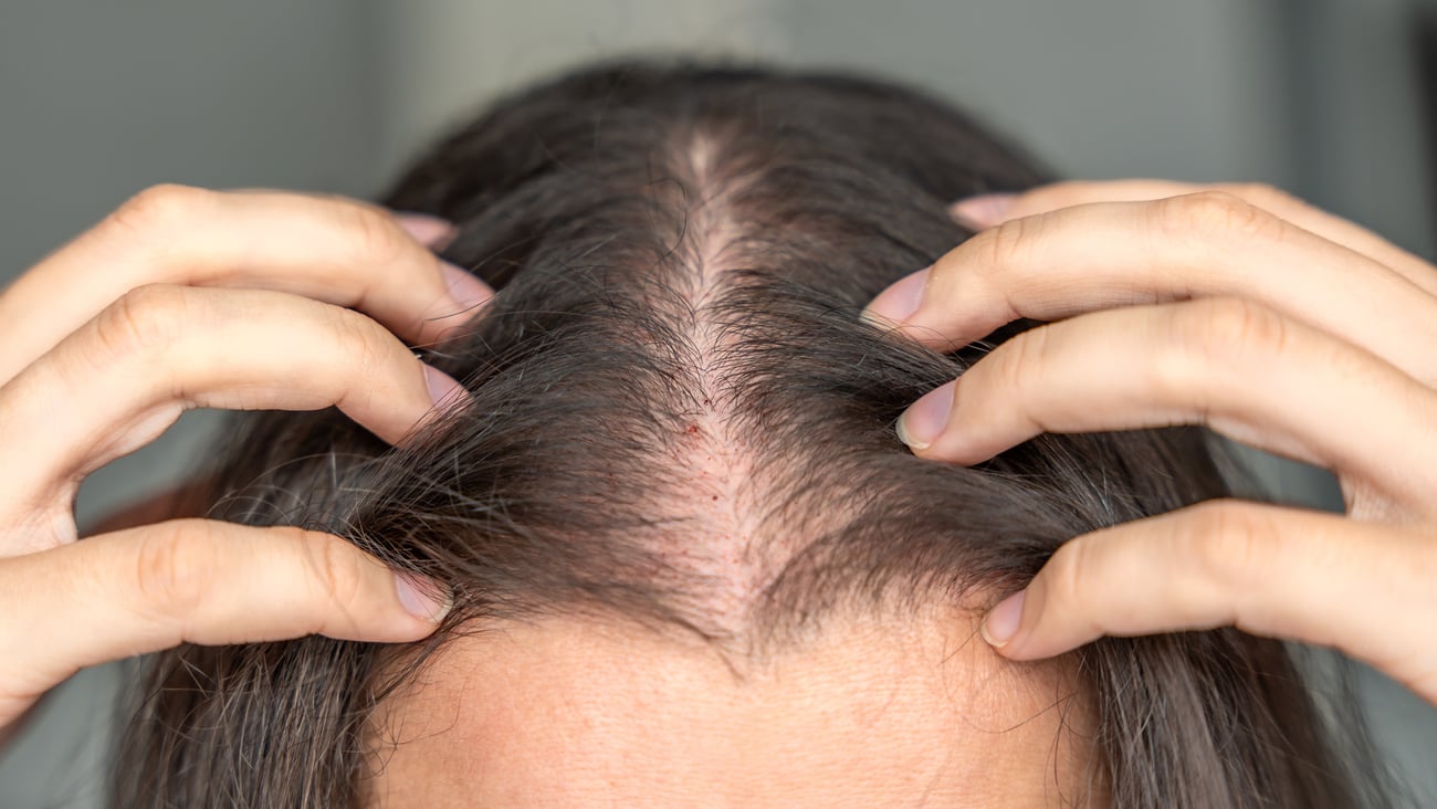 Alopécie chez la femme