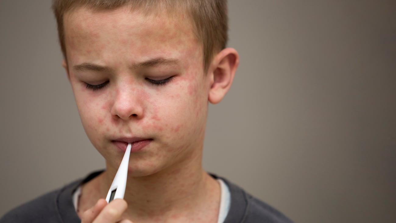 Un enfant qui a la rougeole. Crédit photo: Bilanol/ Getty Images
