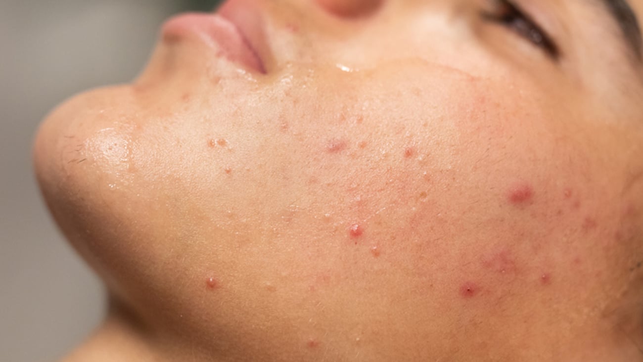 Gros plan sur le visage d'une personne atteinte d'acné vulgaire.