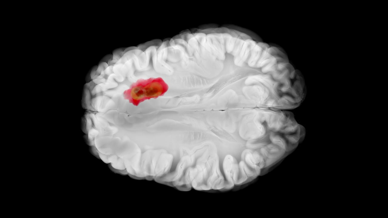 Glioblastome cancer du cerveau