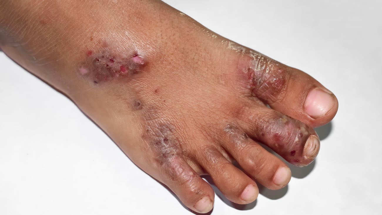 Scabies infection on a foot - infection par la gale sur un pied