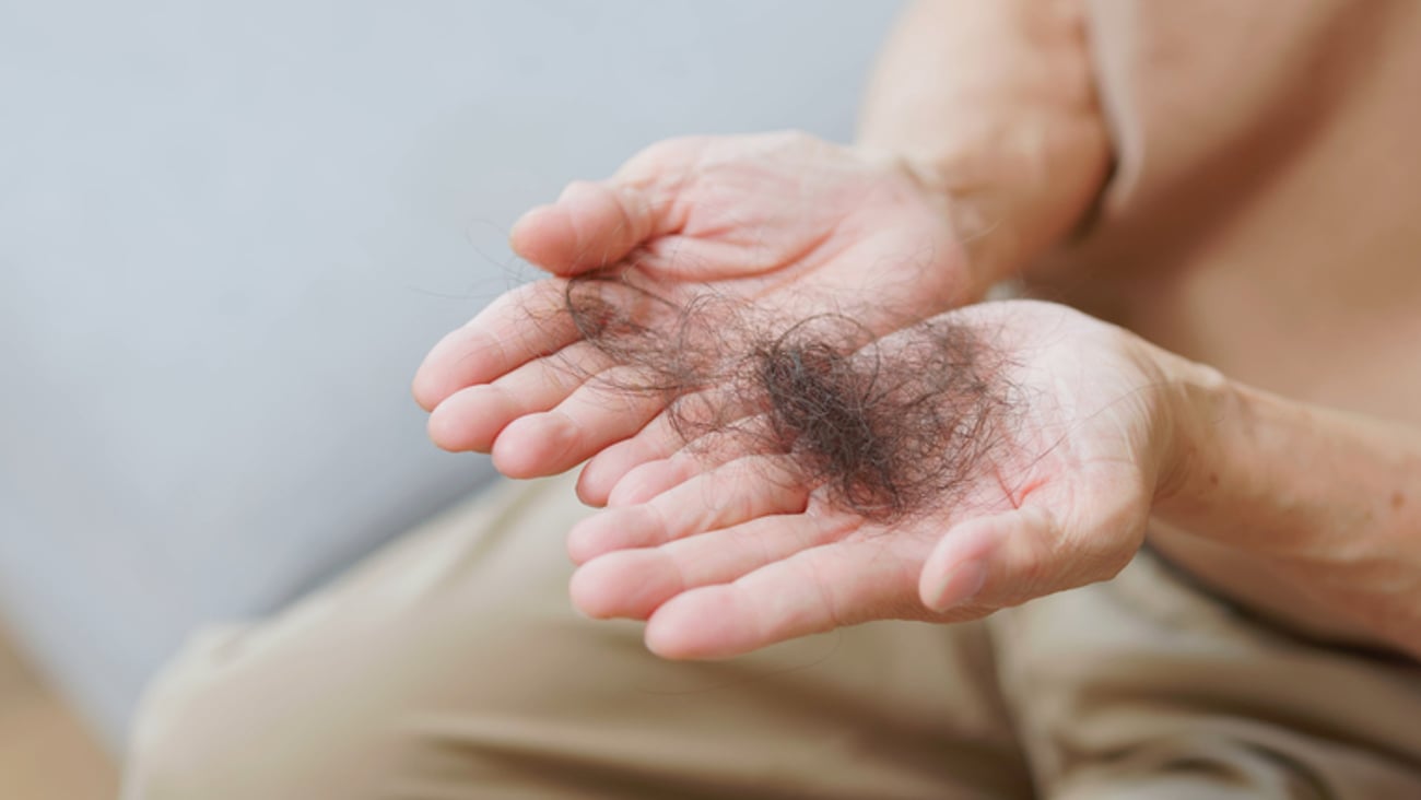 Un homme qui perd ses cheveux en a un tas dans ses mains.