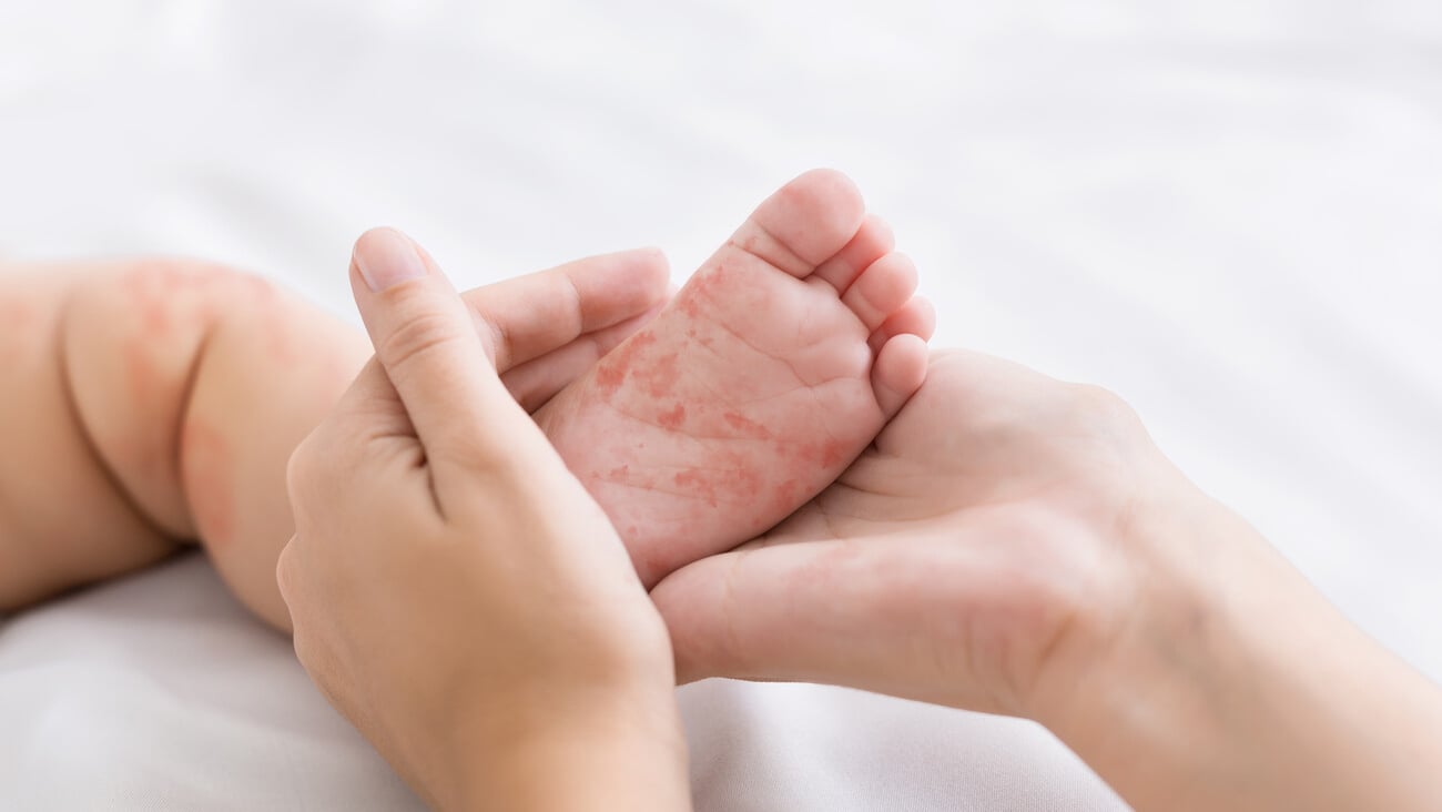 Measles virus. Mother holding tiny baby foot with red rash, closeup; Shutterstock ID 1391758724