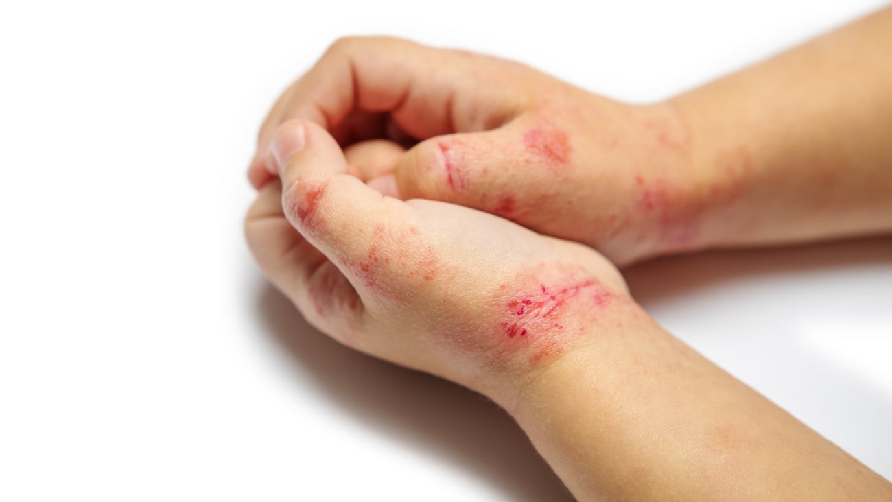children hand with dermatitis. eczema on hand. Isolated on the white background; Shutterstock ID 1563646075