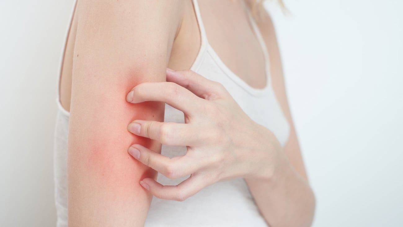 Itchy skin, girl scratches hand; Shutterstock ID 772021855