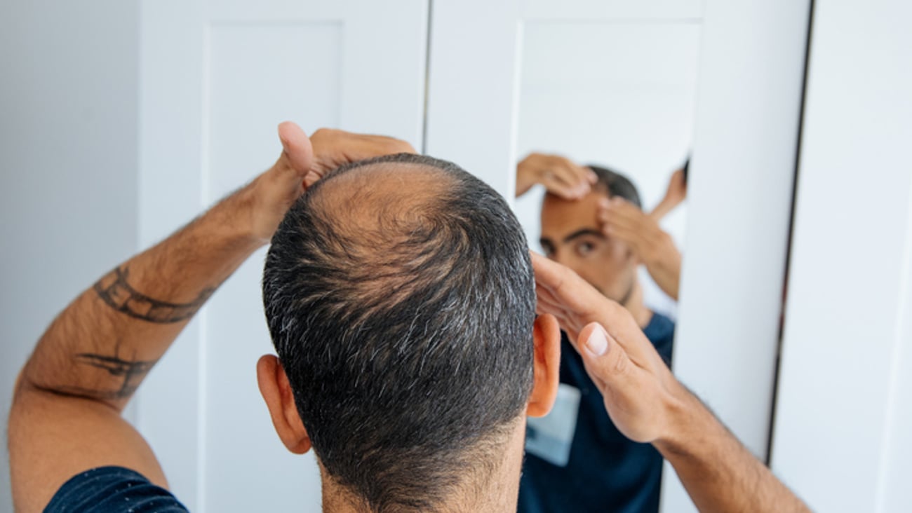 Un homme atteint de calvitie scrute sa chevelure dans un miroir.