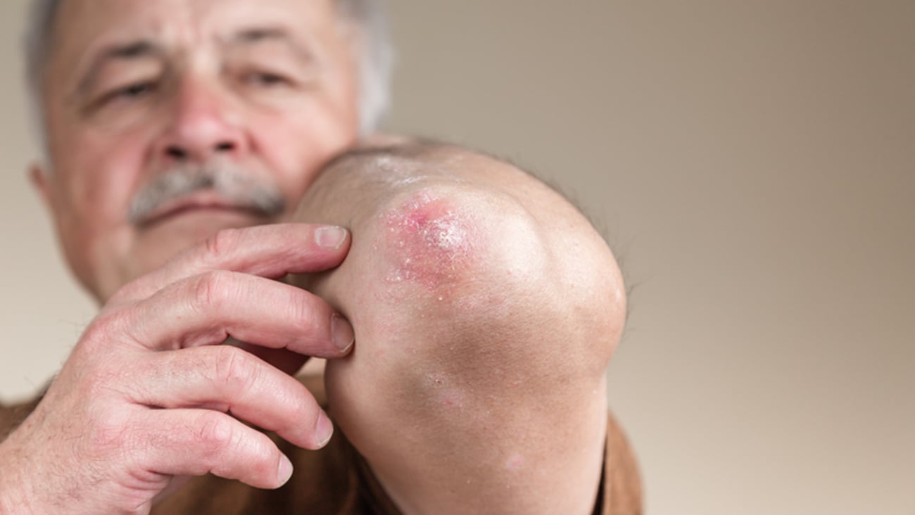 Un homme âgé souffre d'eczéma au coude