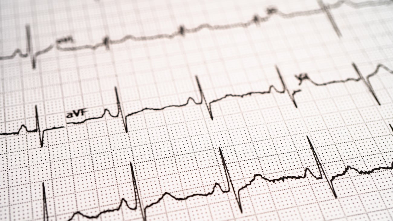 électrocardiogramme