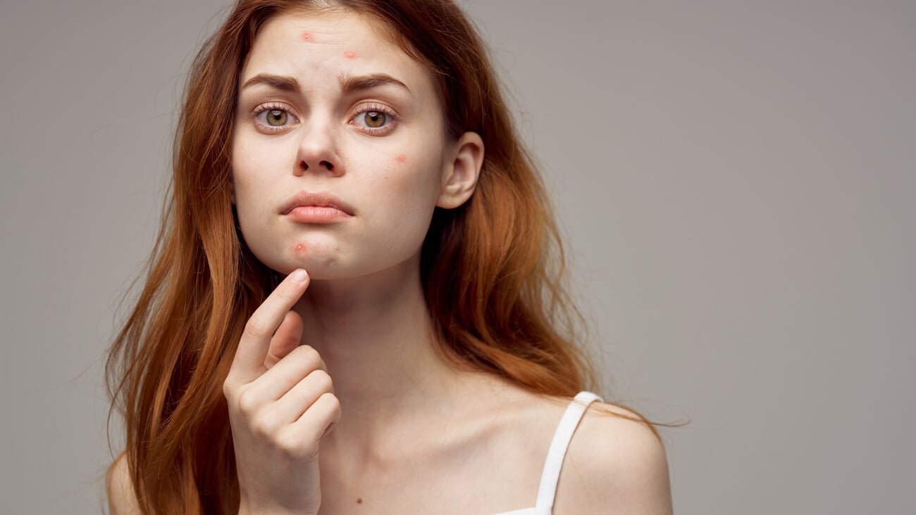 redheaded woman shows fingers on acne on her face                        ; Shutterstock ID 1242995620