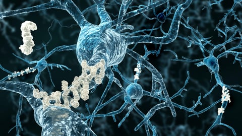 Plaques d'amyloid fixées sur des réseaux neuronaux 