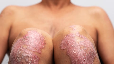 Une femme à la peau de couleur souffre de psoriasis sur les genoux.