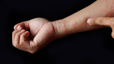 Un homme a une réaction cutanée sur le bras, comme une allergie ou une dermatite atopique.