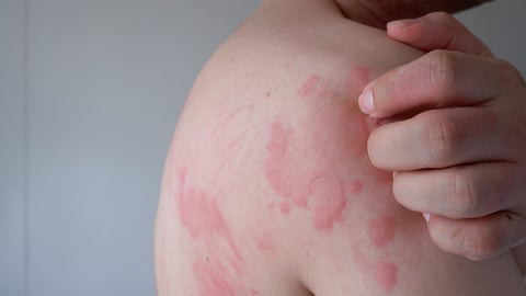 Un homme souffre d'une éruption cutanée, comme des allergies ou l'urticaire.