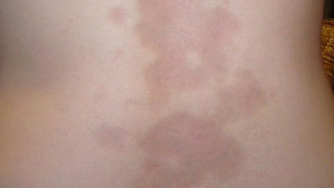 Une sclérodermie localisée (Morphée) située dans le dos d'une femme caucasienne de 16 ans. (Crédit: Leith C Jones/Wikipedia/CC BY 3.0)