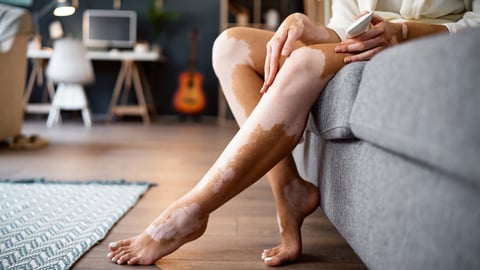 Une femme a du vitiligo sur les jambes.