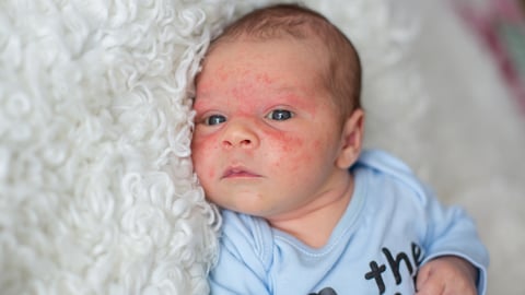 Un nourrisson souffrant d'eczéma sur le visage.
