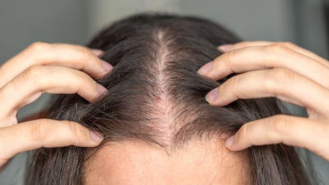 Alopécie chez la femme