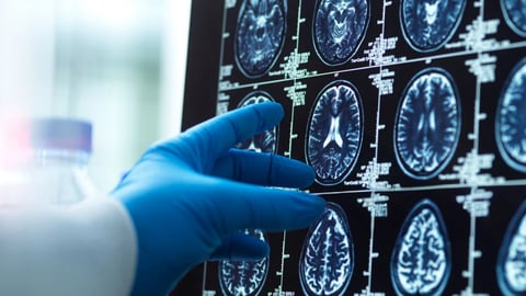 La main d'un médecin portant un gant chirurgical pointant vers une image de scanner cérébral sur un écran d'ordinateur. Crédit photo: Martin Philip/Getty Images 