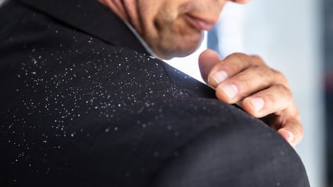 Pellicules sur l'épaule