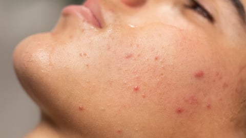 Gros plan sur le visage d'une personne atteinte d'acné vulgaire.