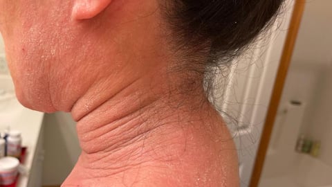 Photo d'une femme dont le visage, le cou et les épaules présentent des symptômes de TSW. Crédit photo: Shutterstock.