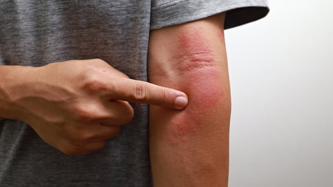 Un homme présente une cellulite (inflammation de la peau) sur son avant-bras