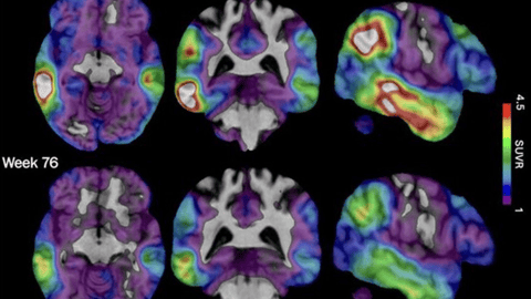 Ces images de scanner cérébral fournies par Biogen montrent comment les taux élevés de protéine tau associée à la maladie d'Alzheimer, représentés en rouge, ont diminué chez un patient ayant reçu le médicament expérimental de la société, le diranersen. (Biogen via AP)
