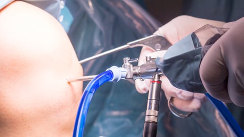 Arthroscopie du genou