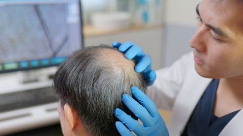 Un médecin ausculte un patient âgé atteint d'alopécie androgénétique, ou calvitie.