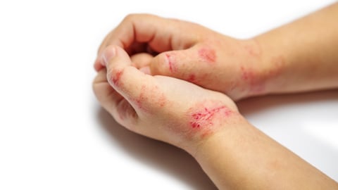 children hand with dermatitis. eczema on hand. Isolated on the white background; Shutterstock ID 1563646075