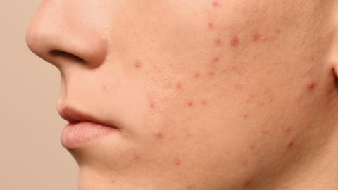 Teen guy with acne problem on beige background, closeup; Shutterstock ID 1588965451