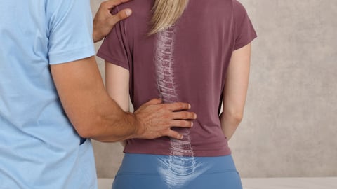 Scoliosis Spine Curve Anatomy, Posture Correction. Chiropractic treatment, Back pain relief.; Shutterstock ID 1819074749