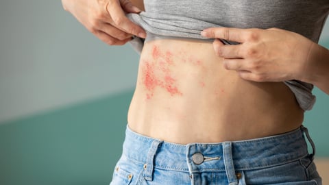 Woman with shingles on the skin she feels very painful; Shutterstock ID 2344606947