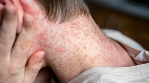 white Teenager covered in measles rash, infectious diseases.; Shutterstock ID 2462470277
