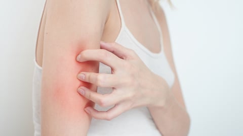 Itchy skin, girl scratches hand; Shutterstock ID 772021855