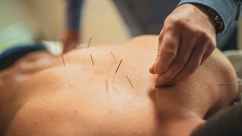 acupuncture