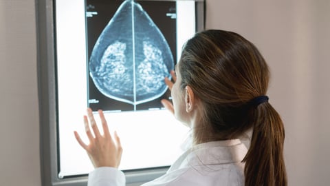 Une médecin consulte une radiographie de cancer du sein