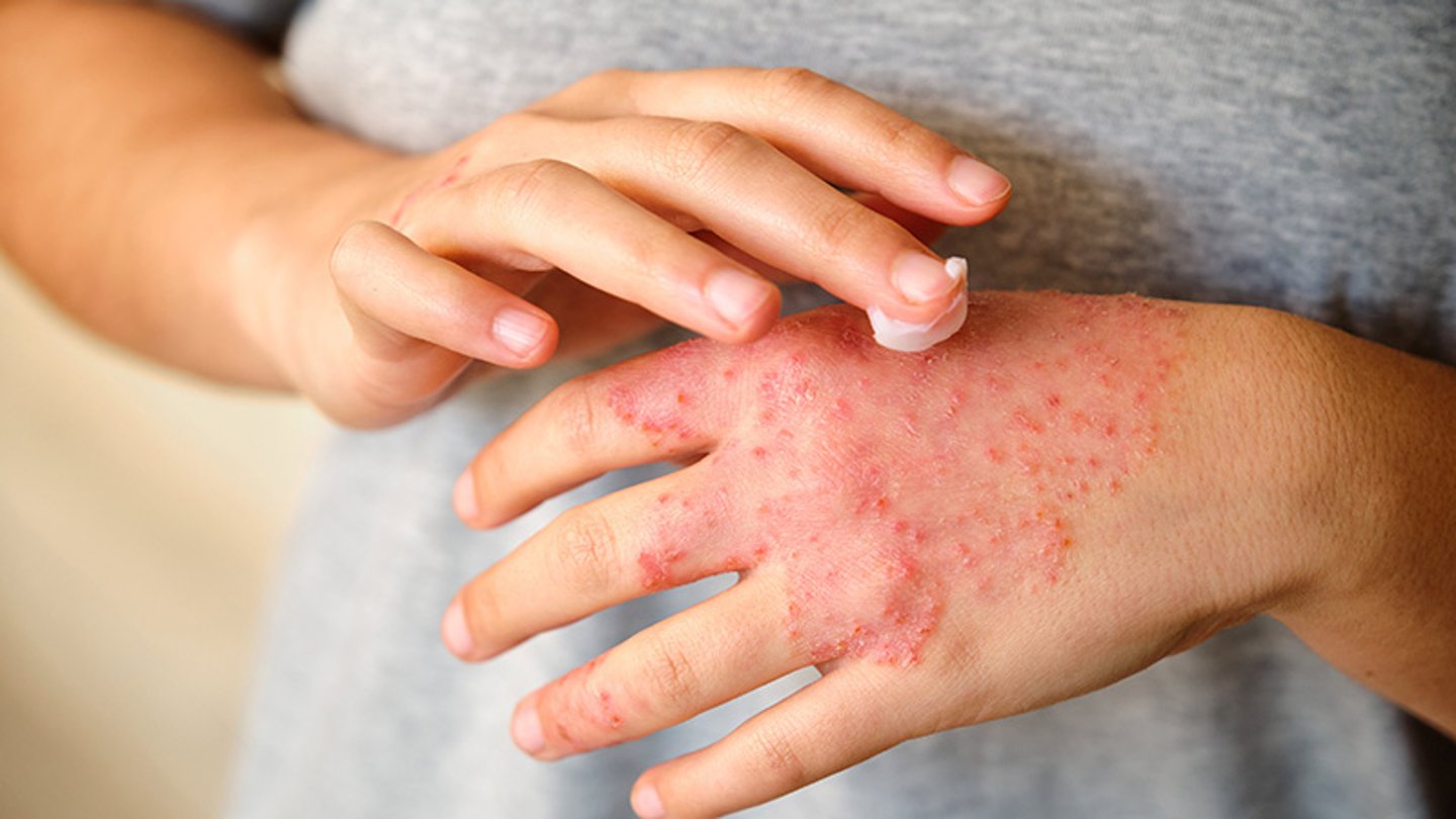 gros plan d'une personne appliquant une crème sur sa main enflammée